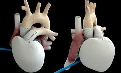 人工心臟技術(shù)未來可期